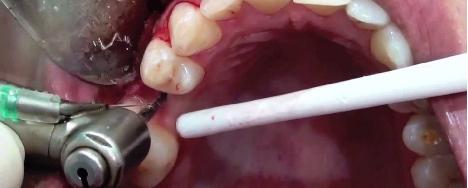 Imagen de cirugía dental