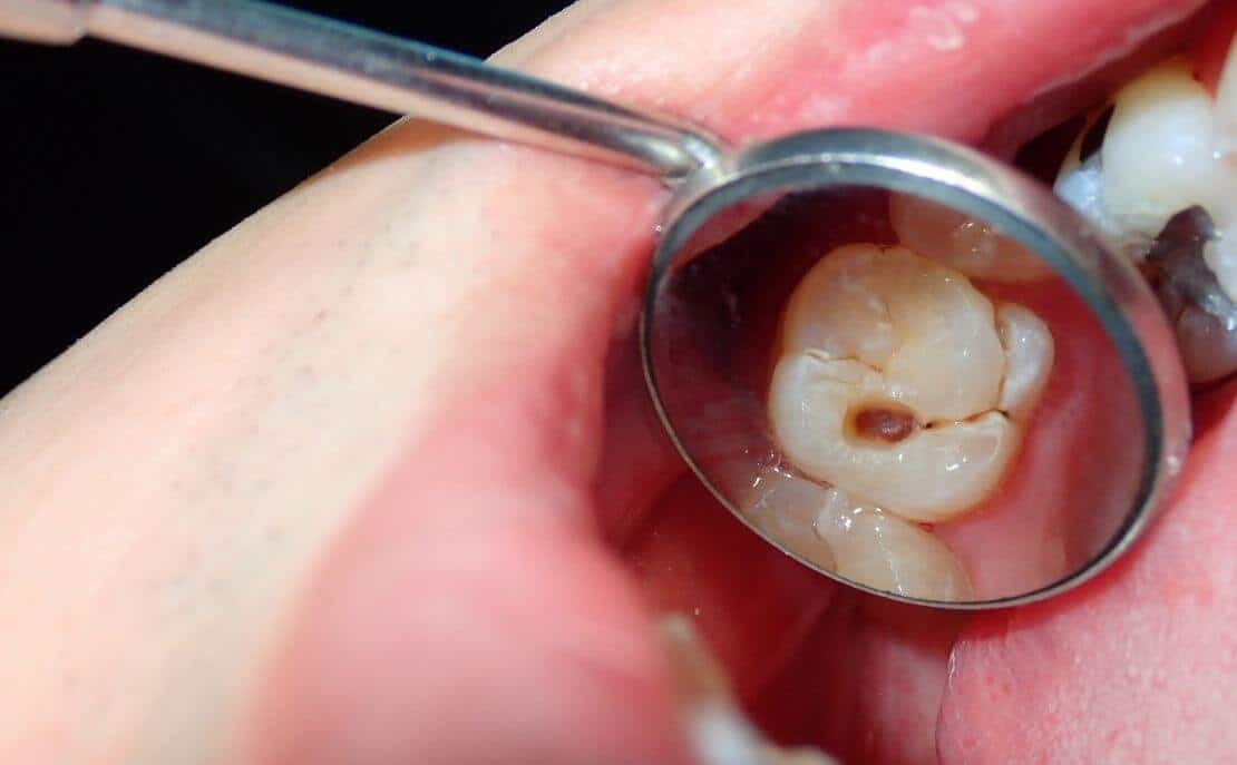 Endodoncia