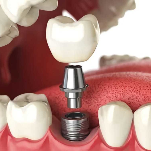 Imagen de cirugia dental