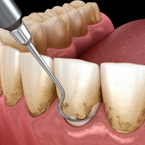 Periodoncia