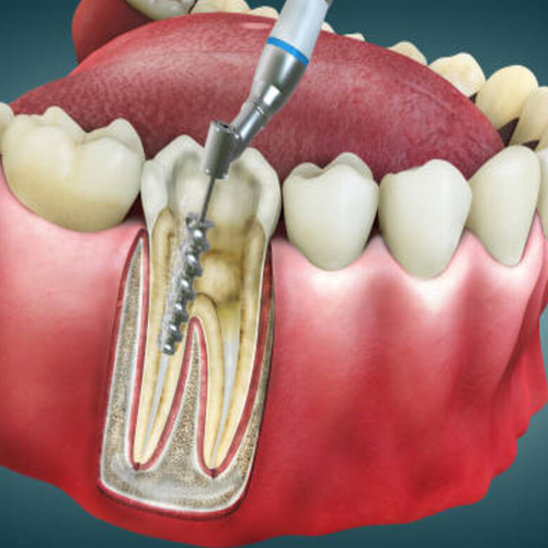 Root Canal