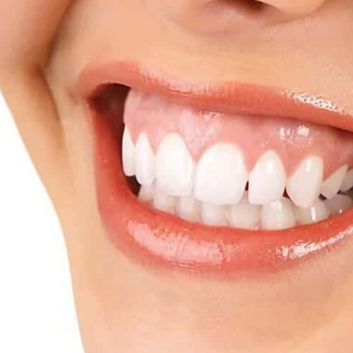 Sonrisa Gingival