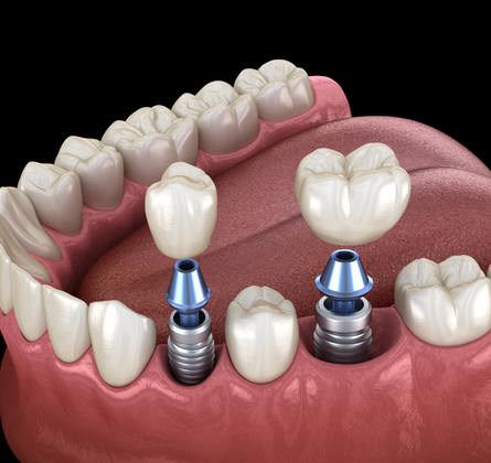 Implantes Dentales