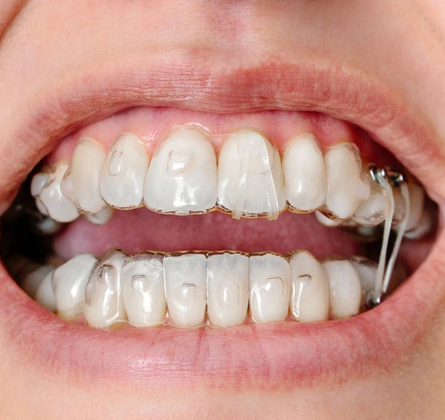 Ortodoncia Invisible