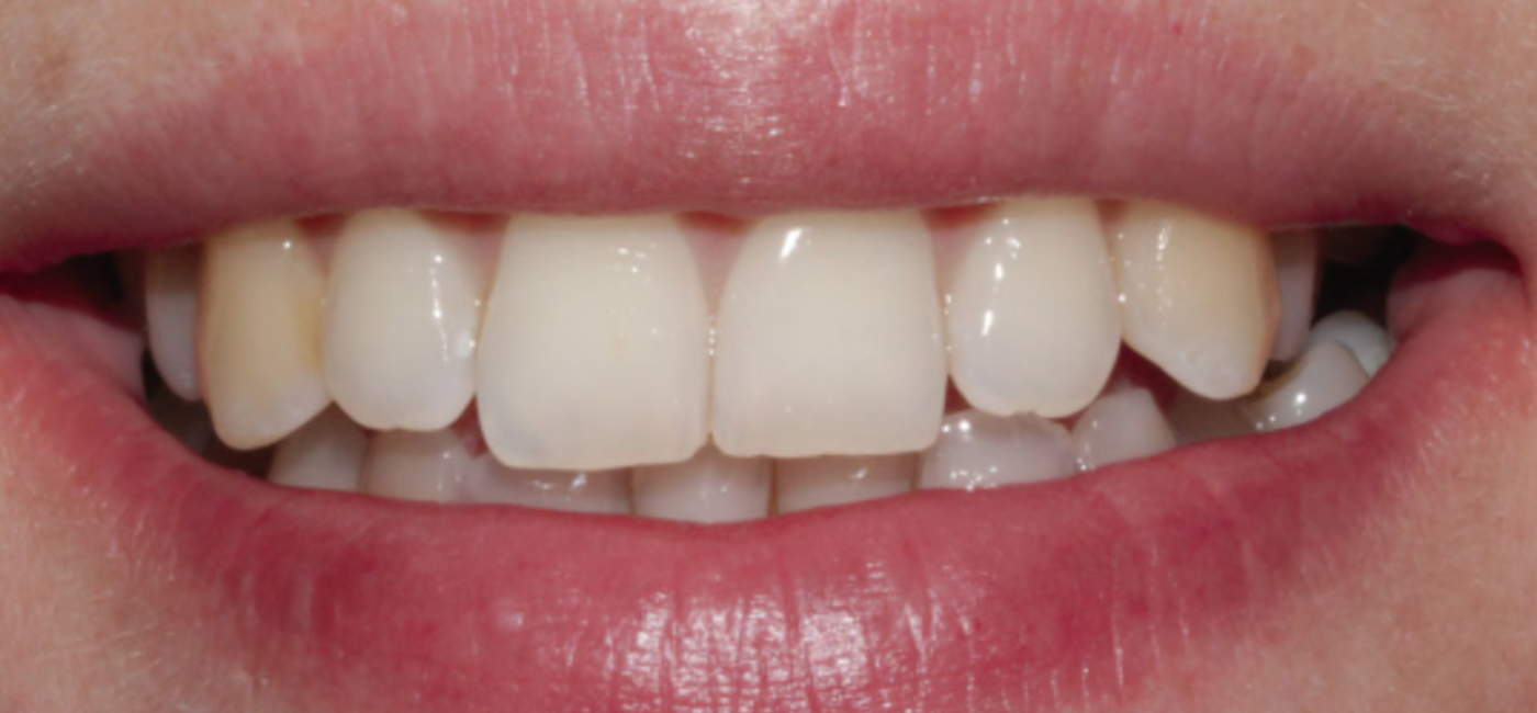 Ortodoncia Invisible