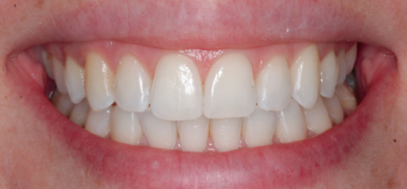 Ortodoncia Invisible