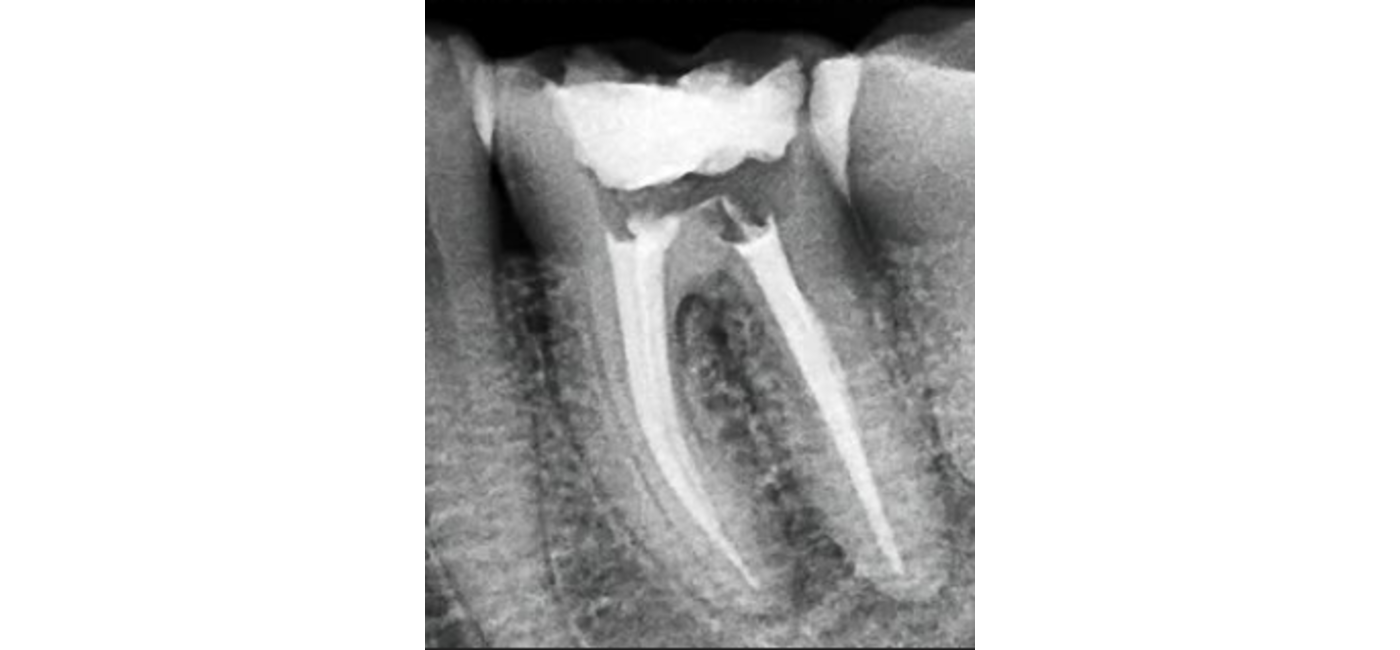 Root Canal