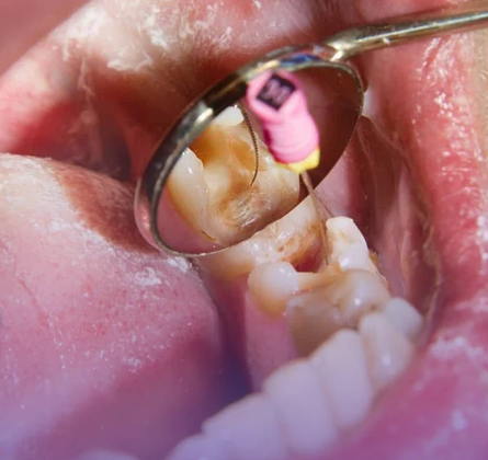 Root Canal