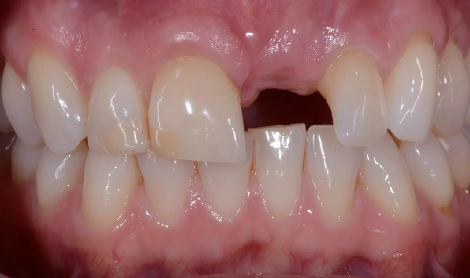 Traumatismos Dentales